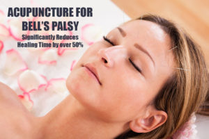 Acupuncture for Bell's Palsy in Palm Beach Gardens Florida